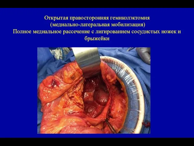 Открытая правосторонняя гемиколэктомия (медиально-латеральная мобилизация) Полное медиальное рассечение с лигированием сосудистых ножек и брыжейки