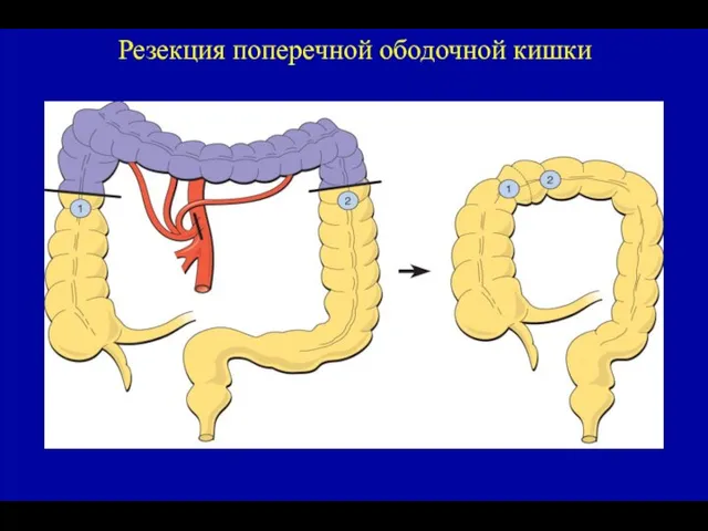 Резекция поперечной ободочной кишки