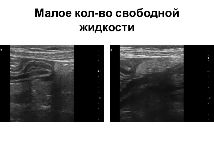 Малое кол-во свободной жидкости