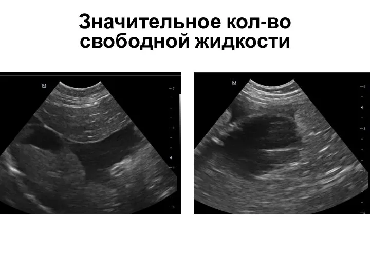 Значительное кол-во свободной жидкости