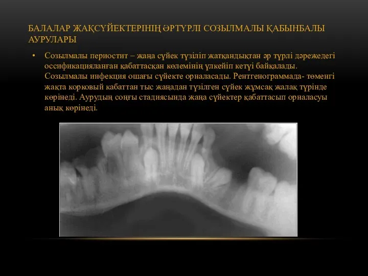 БАЛАЛАР ЖАҚСҮЙЕКТЕРІНІҢ ӘРТҮРЛІ СОЗЫЛМАЛЫ ҚАБЫНБАЛЫ АУРУЛАРЫ Созылмалы периостит – жаңа сүйек түзіліп