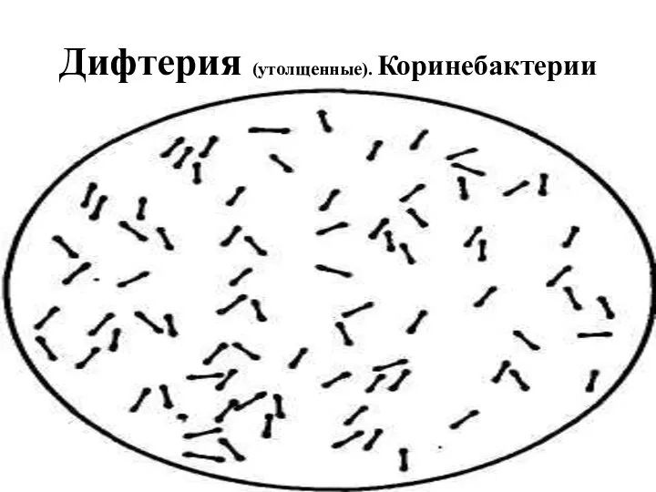 Дифтерия (утолщенные). Коринебактерии