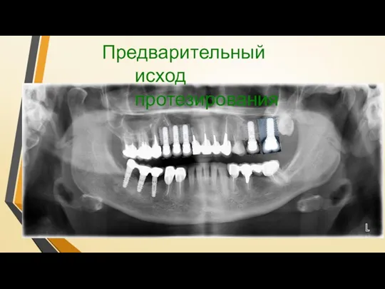 Предварительный исход протезирования