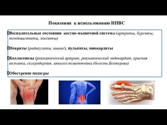 Показания к использованию НПВС Воспалительные состояния костно-мышечной системы (артриты, бурситы, тендовагиниты, миозиты)