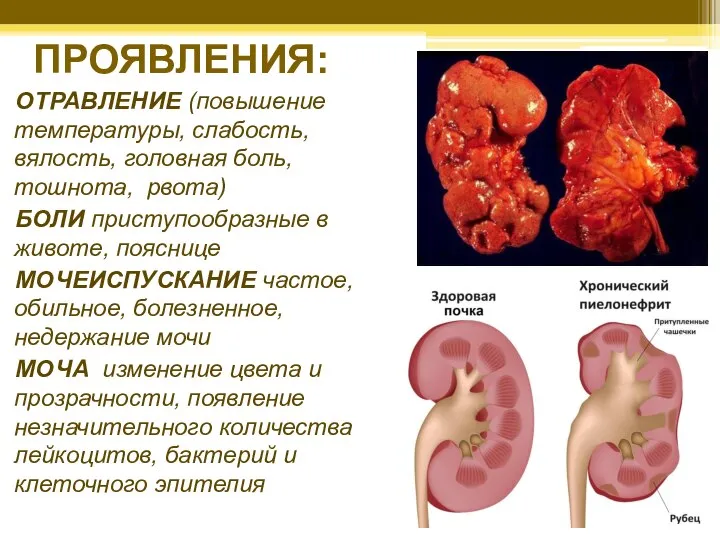 ПРОЯВЛЕНИЯ: ОТРАВЛЕНИЕ (повышение температуры, слабость, вялость, головная боль, тошнота, рвота) БОЛИ приступообразные