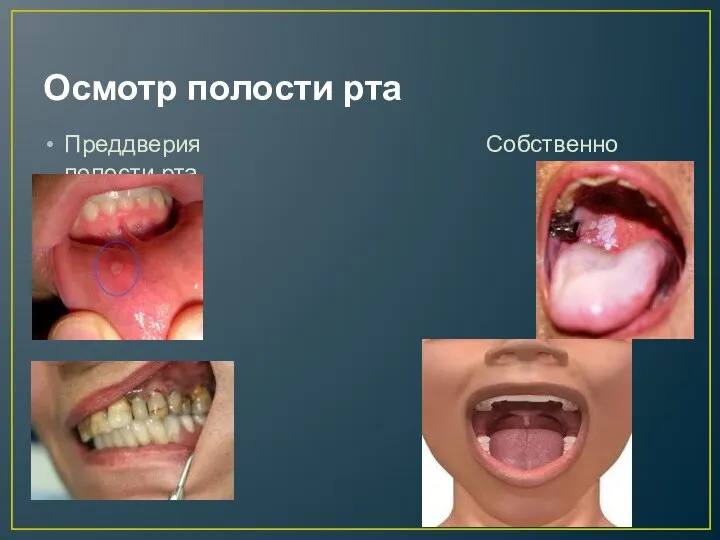 Осмотр полости рта Преддверия Собственно полости рта