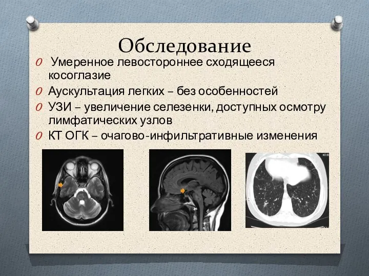 Обследование Умеренное левостороннее сходящееся косоглазие Аускультация легких – без особенностей УЗИ –