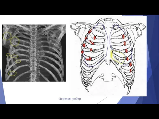 Перелом ребер