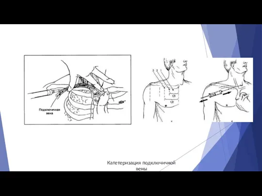 Катетеризация подключичной вены