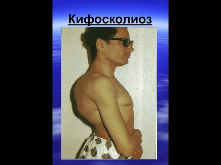 Кифосколиоз