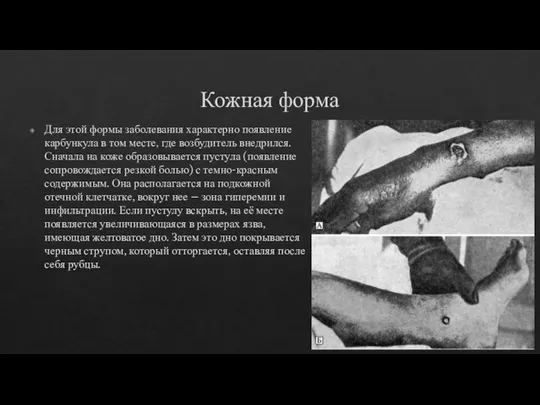 Кожная форма Для этой формы заболевания характерно появление карбункула в том месте,