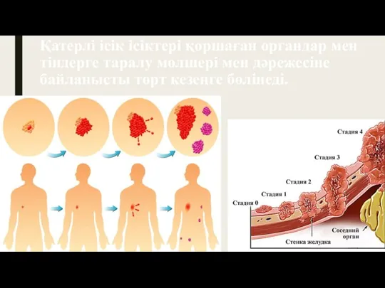 Қатерлі ісік ісіктері қоршаған органдар мен тіндерге таралу мөлшері мен дәрежесіне байланысты төрт кезеңге бөлінеді.
