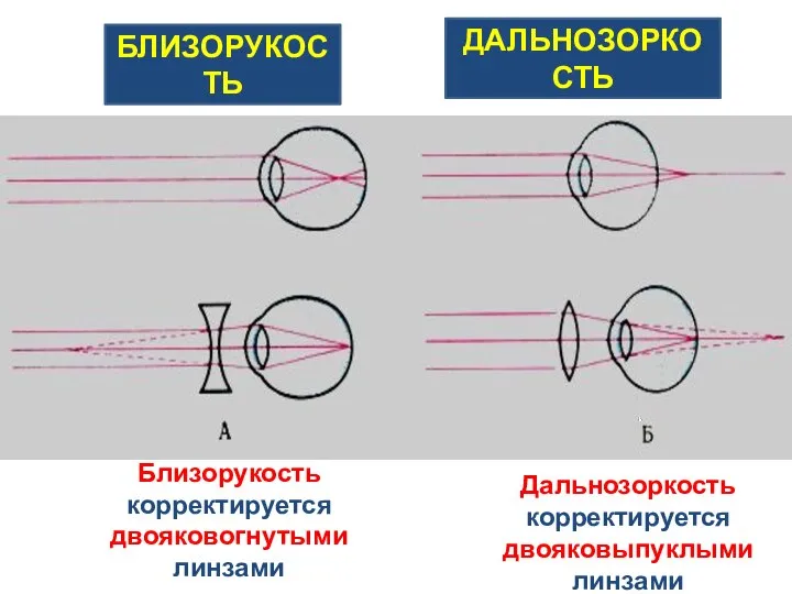 БЛИЗОРУКОСТЬ ДАЛЬНОЗОРКОСТЬ Близорукость корректируется двояковогнутыми линзами Дальнозоркость корректируется двояковыпуклыми линзами