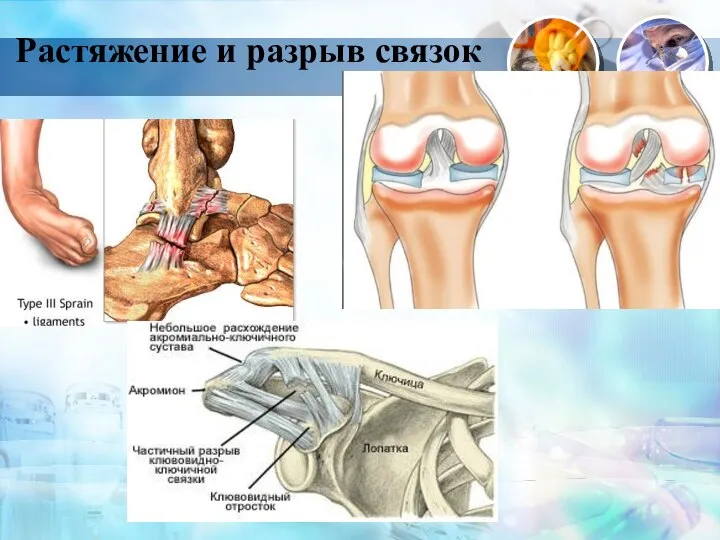 Растяжение и разрыв связок