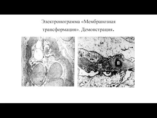 Электронограмма «Мембранозная трансформация». Демонстрация.