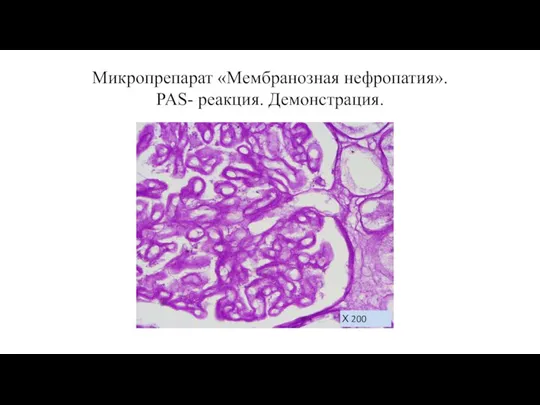 Микропрепарат «Мембранозная нефропатия». PAS- реакция. Демонстрация. Х 200