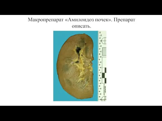 Макропрепарат «Амилоидоз почек». Препарат описать.