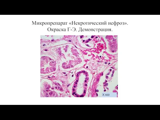 Микропрепарат «Некротический нефроз». Окраска Г-Э. Демонстрация. Х 400