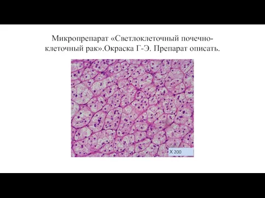 Микропрепарат «Светлоклеточный почечно-клеточный рак».Окраска Г-Э. Препарат описать. Х 200