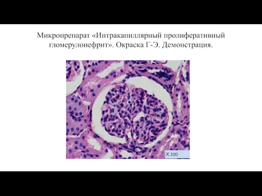 Микропрепарат «Интракапиллярный пролиферативный гломерулонефрит». Окраска Г-Э. Демонстрация. Х 200