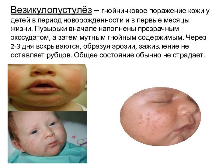Везикулопустулёз – гнойничковое поражение кожи у детей в период новорожденности и в
