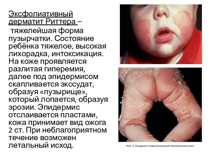 Эксфолиативный дерматит Риттера – тяжелейшая форма пузырчатки. Состояние ребёнка тяжелое, высокая лихорадка,