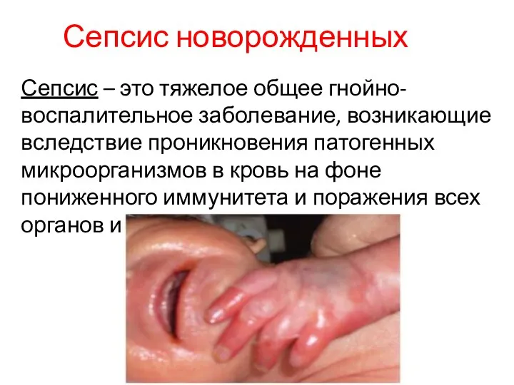 Сепсис новорожденных Сепсис – это тяжелое общее гнойно-воспалительное заболевание, возникающие вследствие проникновения