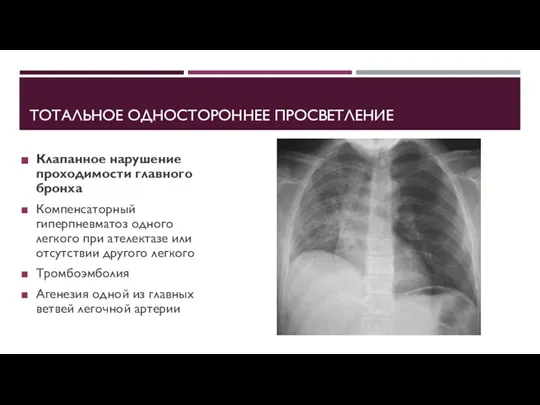 ТОТАЛЬНОЕ ОДНОСТОРОННЕЕ ПРОСВЕТЛЕНИЕ Клапанное нарушение проходимости главного бронха Компенсаторный гиперпневматоз одного легкого