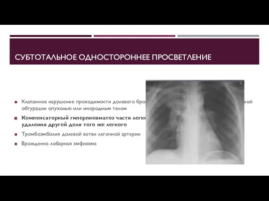 СУБТОТАЛЬНОЕ ОДНОСТОРОННЕЕ ПРОСВЕТЛЕНИЕ Клапанное нарушение проходимости долевого бронха, вследствие его частичной механической