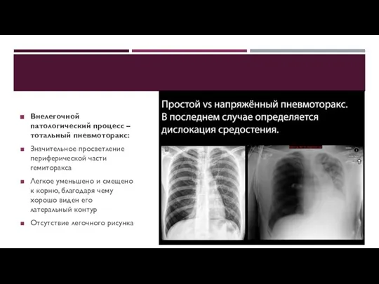 Внелегочной патологический процесс – тотальный пневмоторакс: Значительное просветление периферической части гемиторакса Легкое