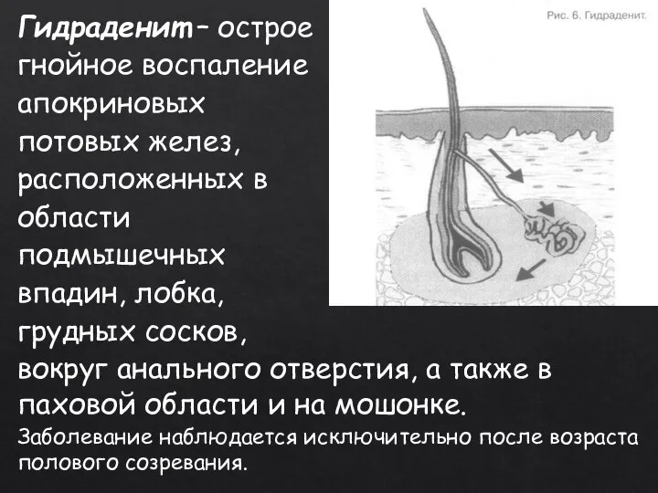 Гидраденит – острое гнойное воспаление апокриновых потовых желез, расположенных в области подмышечных