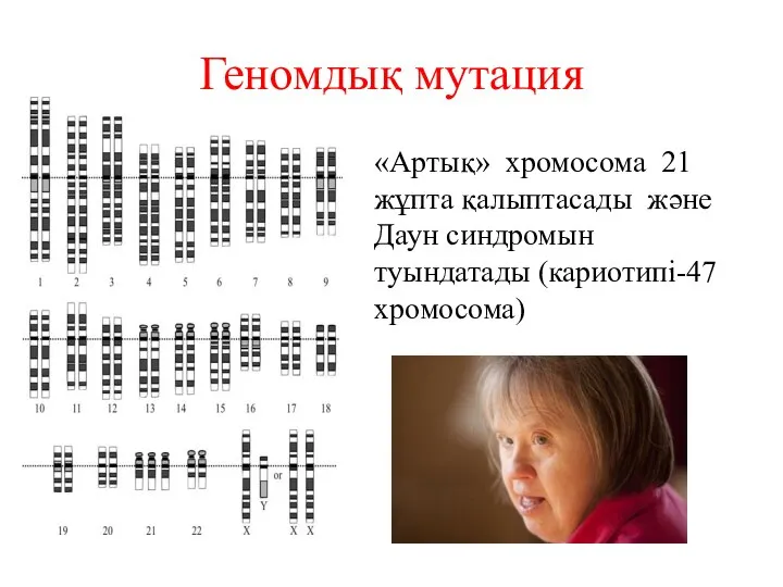 Геномдық мутация «Артық» хромосома 21 жұпта қалыптасады және Даун синдромын туындатады (кариотипі-47 хромосома)