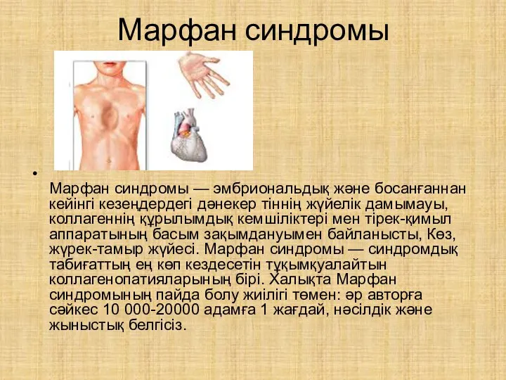 Марфан синдромы Марфан синдромы — эмбриональдық және босанғаннан кейінгі кезеңдердегі дәнекер тіннің