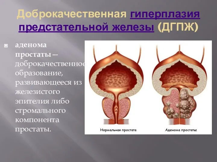 Доброкачественная гиперплазия предстательной железы (ДГПЖ) аденома простаты— доброкачественное образование, развивающееся из железистого