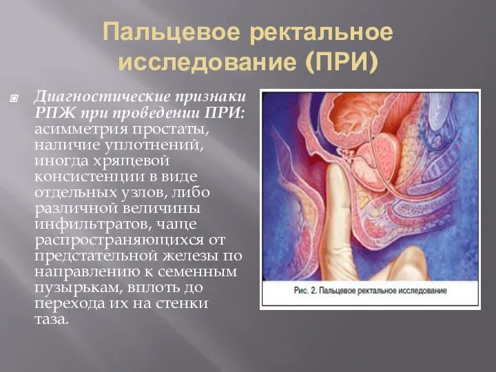 Пальцевое ректальное исследование (ПРИ) Диагностические признаки РПЖ при проведении ПРИ: асимметрия простаты,