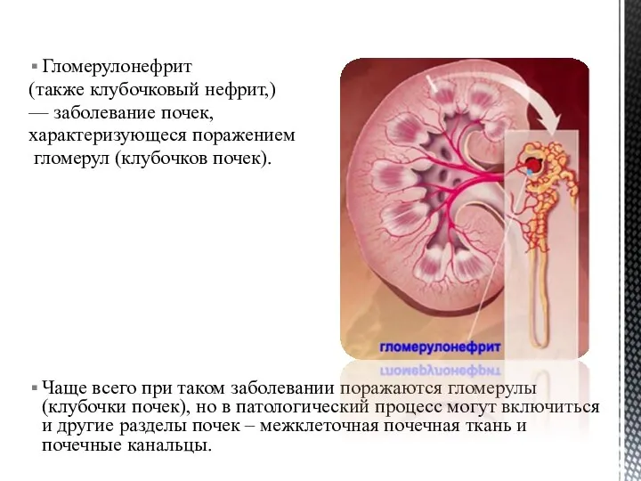 Гломерулонефрит (также клубочковый нефрит,) — заболевание почек, характеризующеся поражением гломерул (клубочков почек).