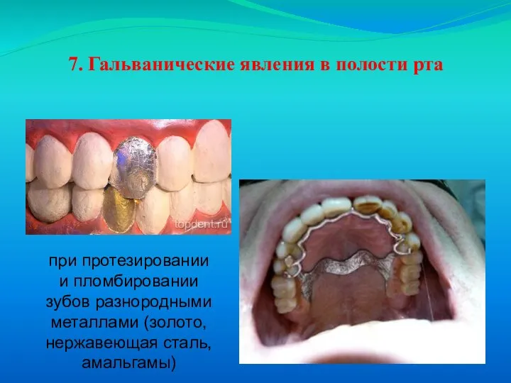 7. Гальванические явления в полости рта при протезировании и пломбировании зубов разнородными