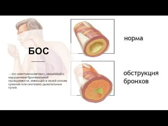 БОС – это симптомокомплекс, связанный с нарушением бронхиальной проходимости, имеющей в своей