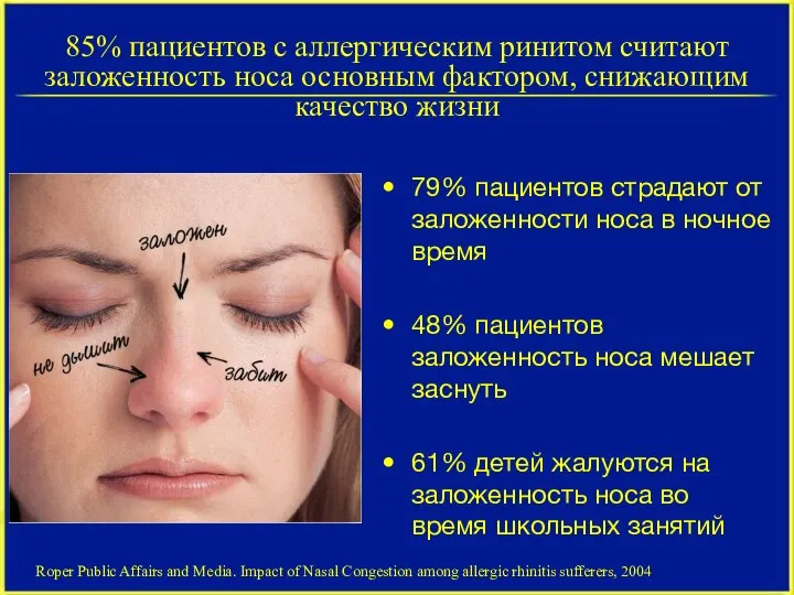 85% пациентов с аллергическим ринитом считают заложенность носа основным фактором, снижающим качество