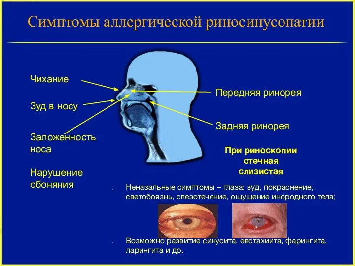 Симптомы аллергической риносинусопатии При риноскопии отечная слизистая Неназальные симптомы – глаза: зуд,
