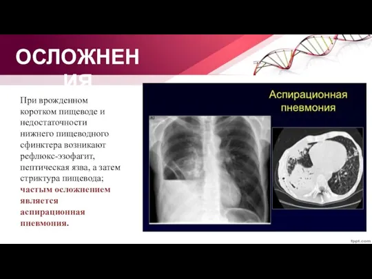 ОСЛОЖНЕНИЯ При врожденном коротком пищеводе и недостаточности нижнего пищеводного сфинктера возникают рефлюкс-эзофагит,