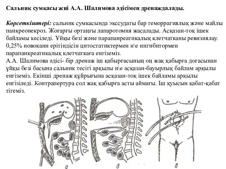 Сальник сумкасы жиі А.А. Шалимова әдісімен дренаждалады. Көрсеткіштері: сальник сумкасында экссудаты бар