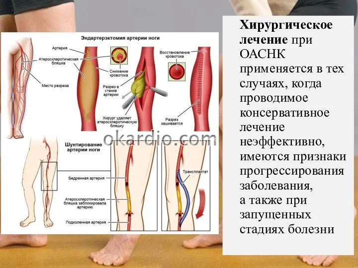 Хирургическое лечение при ОАСНК применяется в тех случаях, когда проводимое консервативное лечение