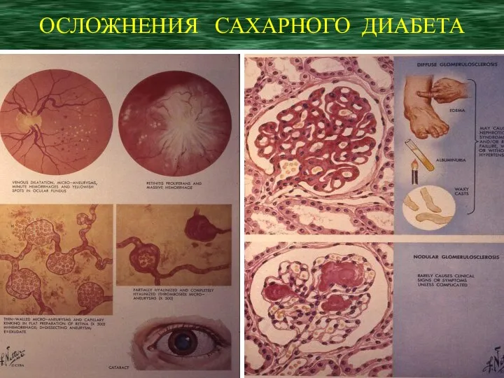 ОСЛОЖНЕНИЯ САХАРНОГО ДИАБЕТА