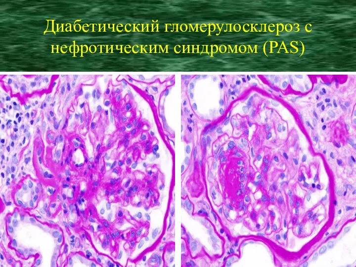 Диабетический гломерулосклероз с нефротическим синдромом (PAS)