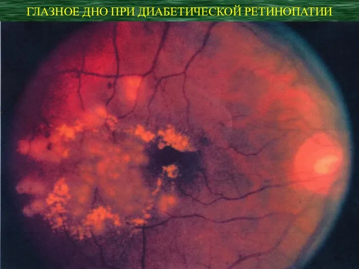 ГЛАЗНОЕ ДНО ПРИ ДИАБЕТИЧЕСКОЙ РЕТИНОПАТИИ