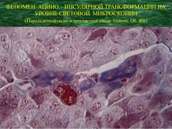 ФЕНОМЕН АЦИНО – ИНСУЛЯРНОЙ ТРАНСФОРМАЦИИ НА УРОВНЕ СВЕТОВОЙ МИКРОСКОПИИ (Паральдегидфуксин и трехцветная смесь Gomori. Об. 40x)