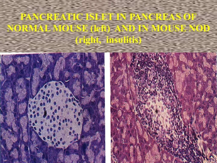 PANCREATIC ISLET IN PANCREAS OF NORMAL MOUSE (left) AND IN MOUSE NOD (right, insulitis)