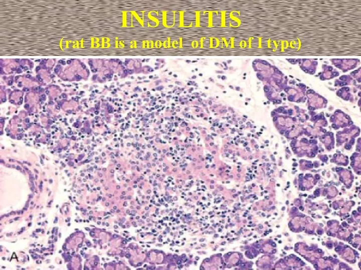 INSULITIS (rat BB is a model of DM of I type)