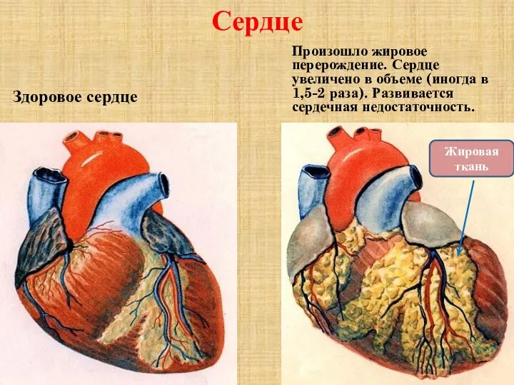 Сердце Здоровое сердце Произошло жировое перерождение. Сердце увеличено в объеме (иногда в